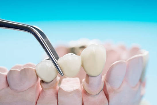 Dental crown and bridge consultation at Gold's Dental Clinic in Kalapatti, Coimbatore
