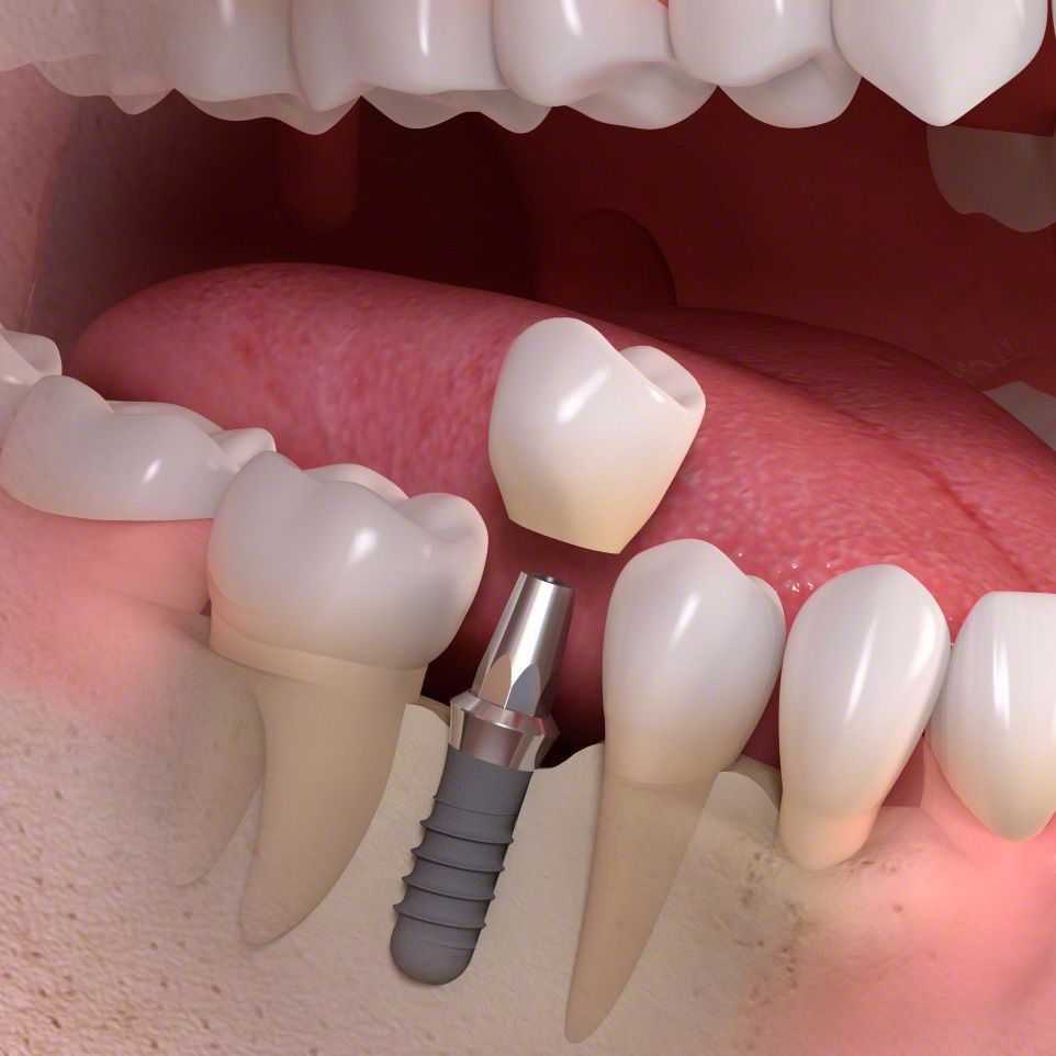 Dental implant fixture, abutment and crown illustration for tooth replacement at Gold's Dental Clinic