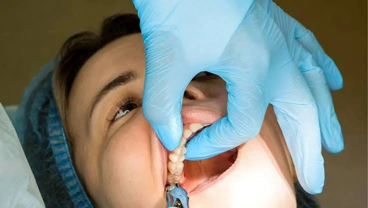 Dentist examining a patient's wisdom tooth before extraction at Gold's Dental Clinic